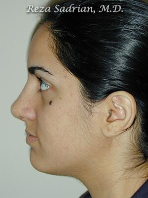 Nose Reshaping Before & After Image