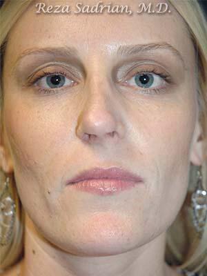 Nose Reshaping Before & After Image