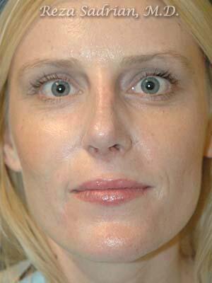 Nose Reshaping Before & After Image