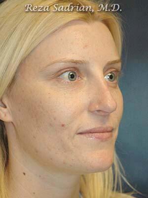 Nose Reshaping Before & After Image