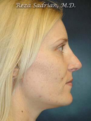 Nose Reshaping Before & After Image