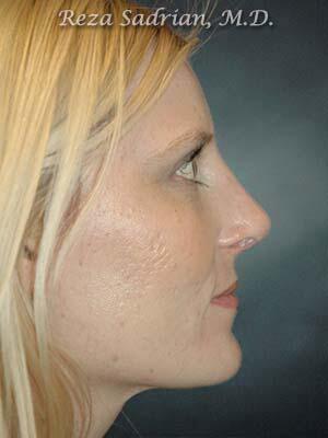 Nose Reshaping Before & After Image