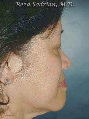 Nose Reshaping Before & After Image