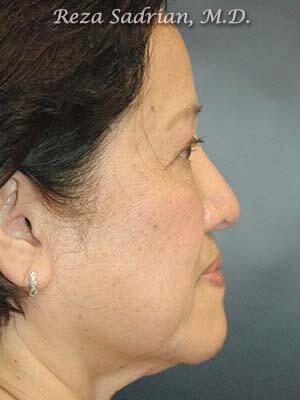 Nose Reshaping Before & After Image