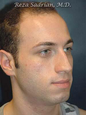 Nose Reshaping Before & After Image