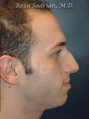 Nose Reshaping Before & After Image