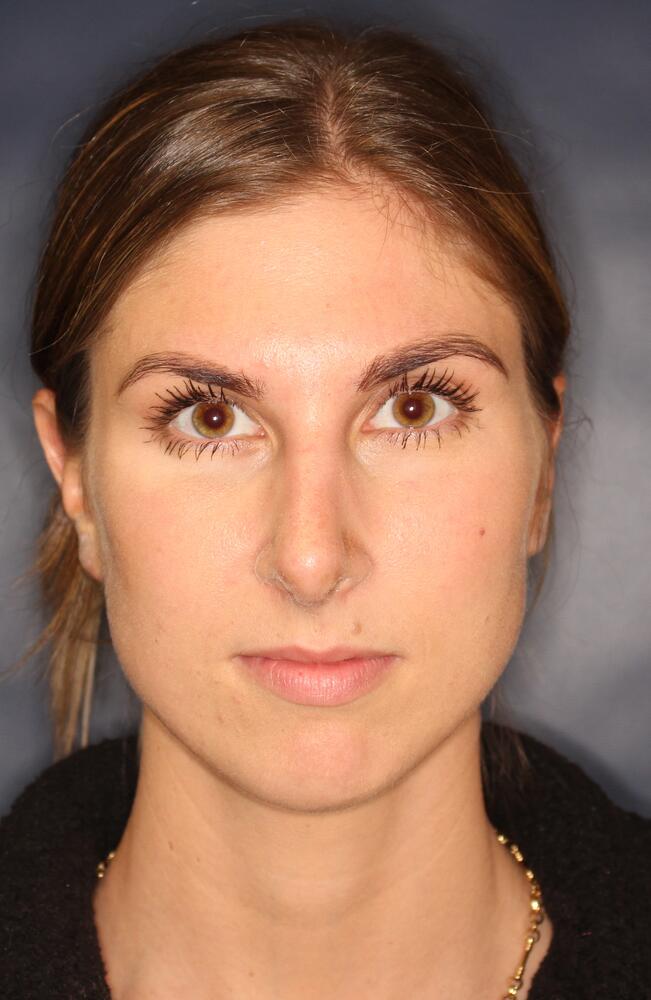Nose Reshaping Before & After Image
