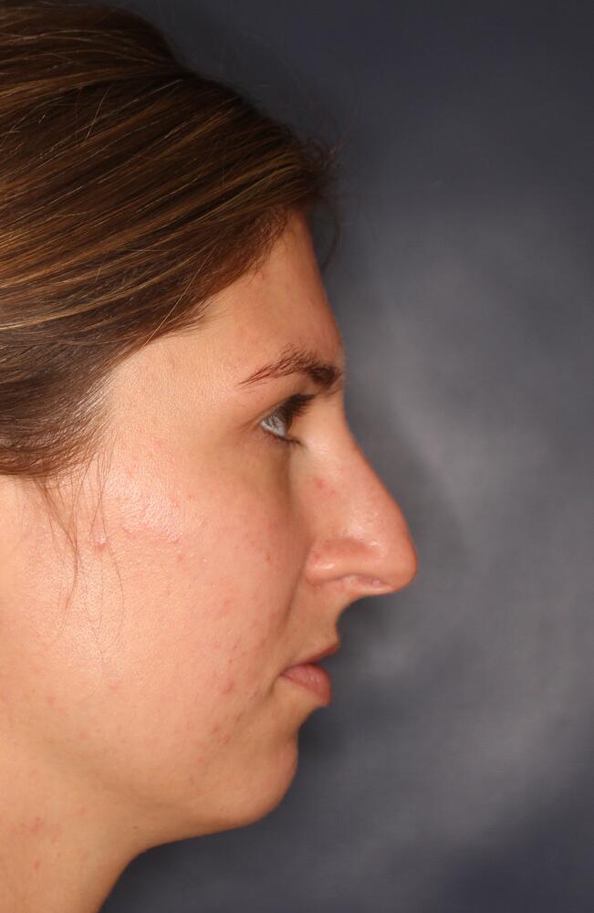 Nose Reshaping Before & After Image