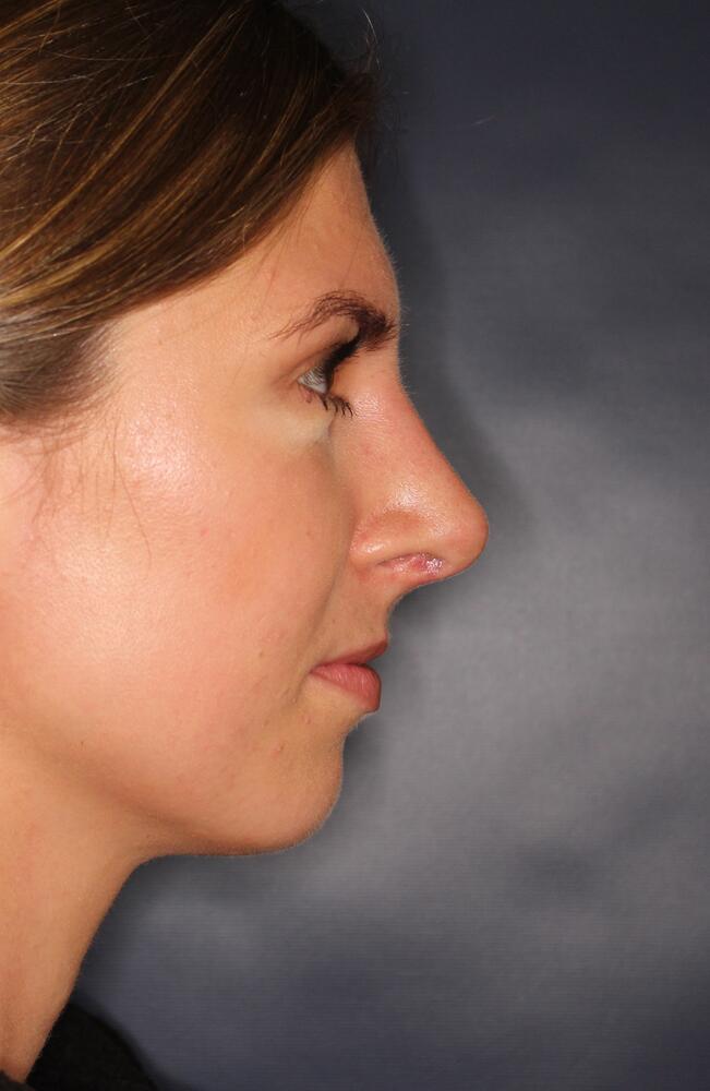 Nose Reshaping Before & After Image