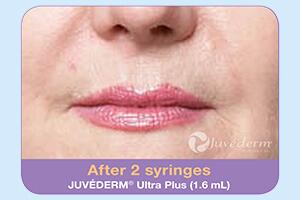 Dermal Fillers Before & After Image