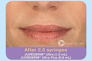 Dermal Fillers Before & After Image