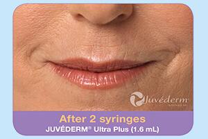 Dermal Fillers Before & After Image