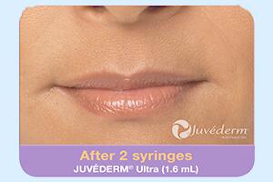 Dermal Fillers Before & After Image