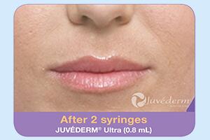 Dermal Fillers Before & After Image