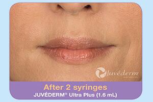 Dermal Fillers Before & After Image