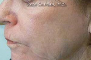 Fractional Resurfacing Before & After Image