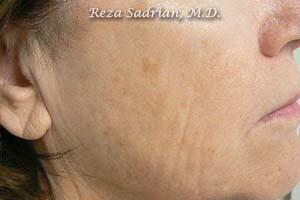 Fractional Resurfacing Before & After Image