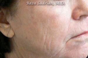 Fractional Resurfacing Before & After Image