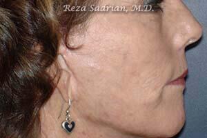 Fractional Resurfacing Before & After Image