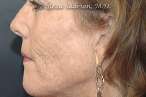 Fractional Resurfacing Before & After Image