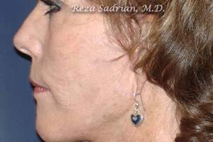 Fractional Resurfacing Before & After Image