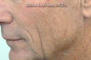 Fractional Resurfacing Before & After Image