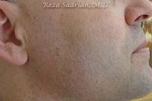 IPL Before & After Image