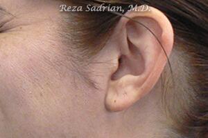 Laser Hair Removal Before & After Image