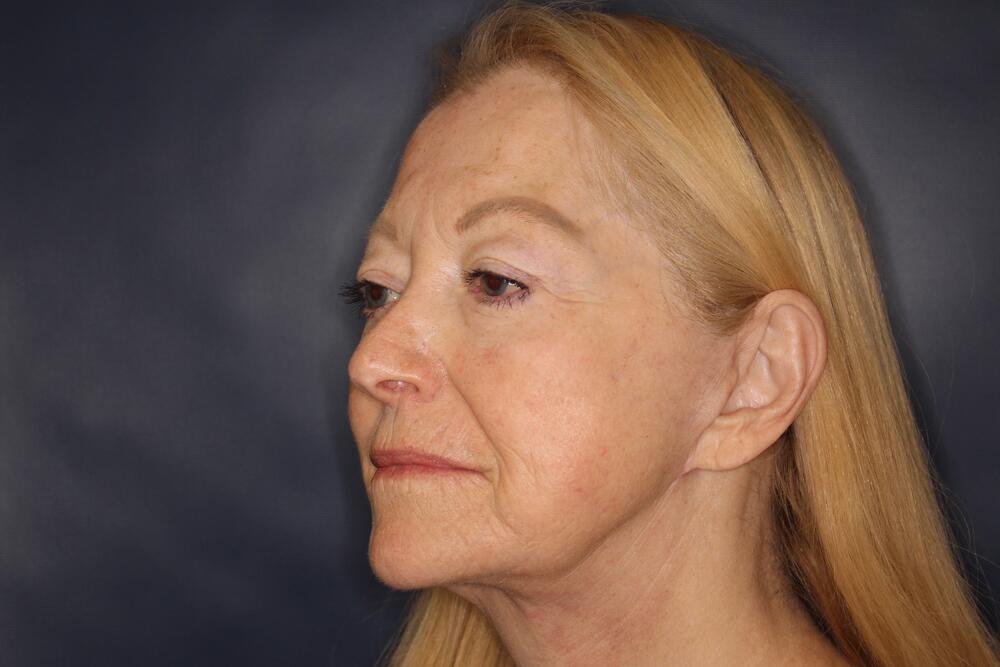 Laser Resurfacing Before & After Image