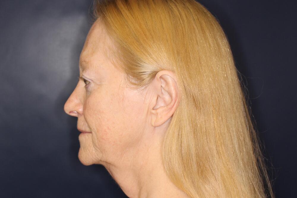 Laser Resurfacing Before & After Image