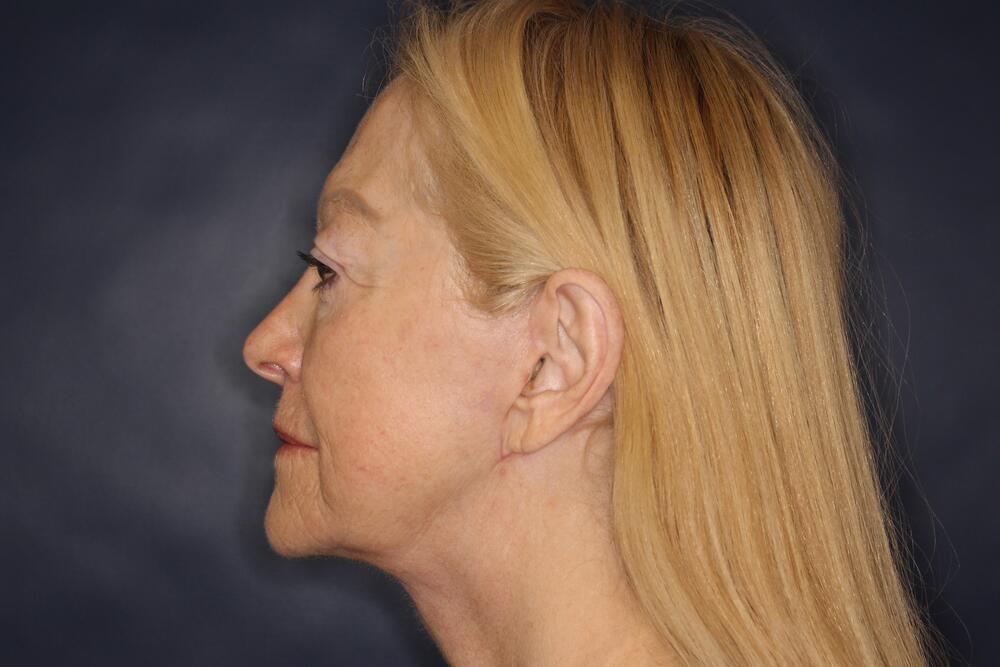 Laser Resurfacing Before & After Image