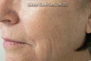 Laser Resurfacing Before & After Image