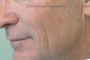 Laser Resurfacing Before & After Image