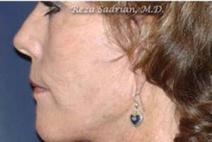 Laser Resurfacing Before & After Image