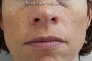 Laser Resurfacing Before & After Image