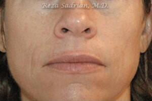 Laser Resurfacing Before & After Image