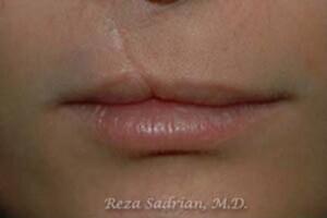 Laser Resurfacing Before & After Image