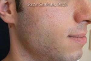 Laser Resurfacing Before & After Image