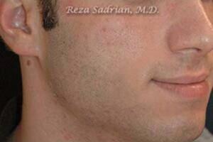 Laser Resurfacing Before & After Image