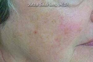 Laser Resurfacing Before & After Image