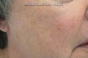 Laser Resurfacing Before & After Image