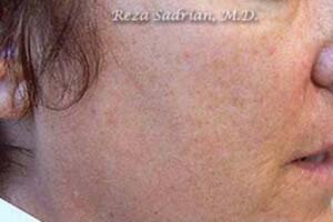 Laser Resurfacing Before & After Image