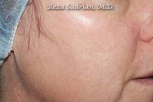 Laser Resurfacing Before & After Image