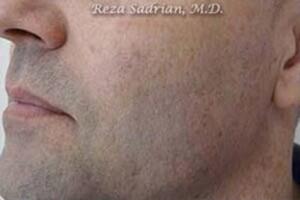 Laser Resurfacing Before & After Image