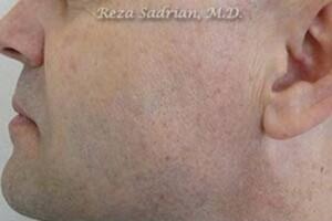 Laser Resurfacing Before & After Image