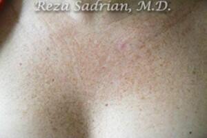 Laser Resurfacing Before & After Image