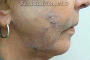 Laser Resurfacing Before & After Image