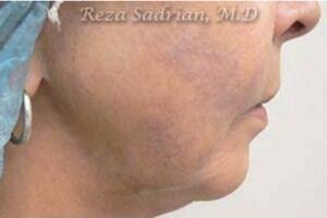 Laser Resurfacing Before & After Image