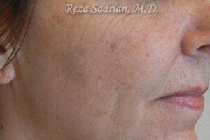 Laser Resurfacing Before & After Image