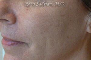 Laser Resurfacing Before & After Image